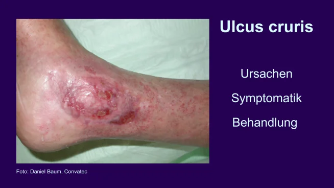 Ulcus cruris, umgangssprachlich auch offenes Bein genannt