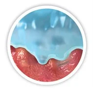 σχέδιο μικροπεριγραμμάτων στον πυθμένα του έλκους 