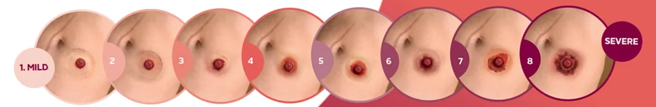 Stadier av peristomale hudproblemer.