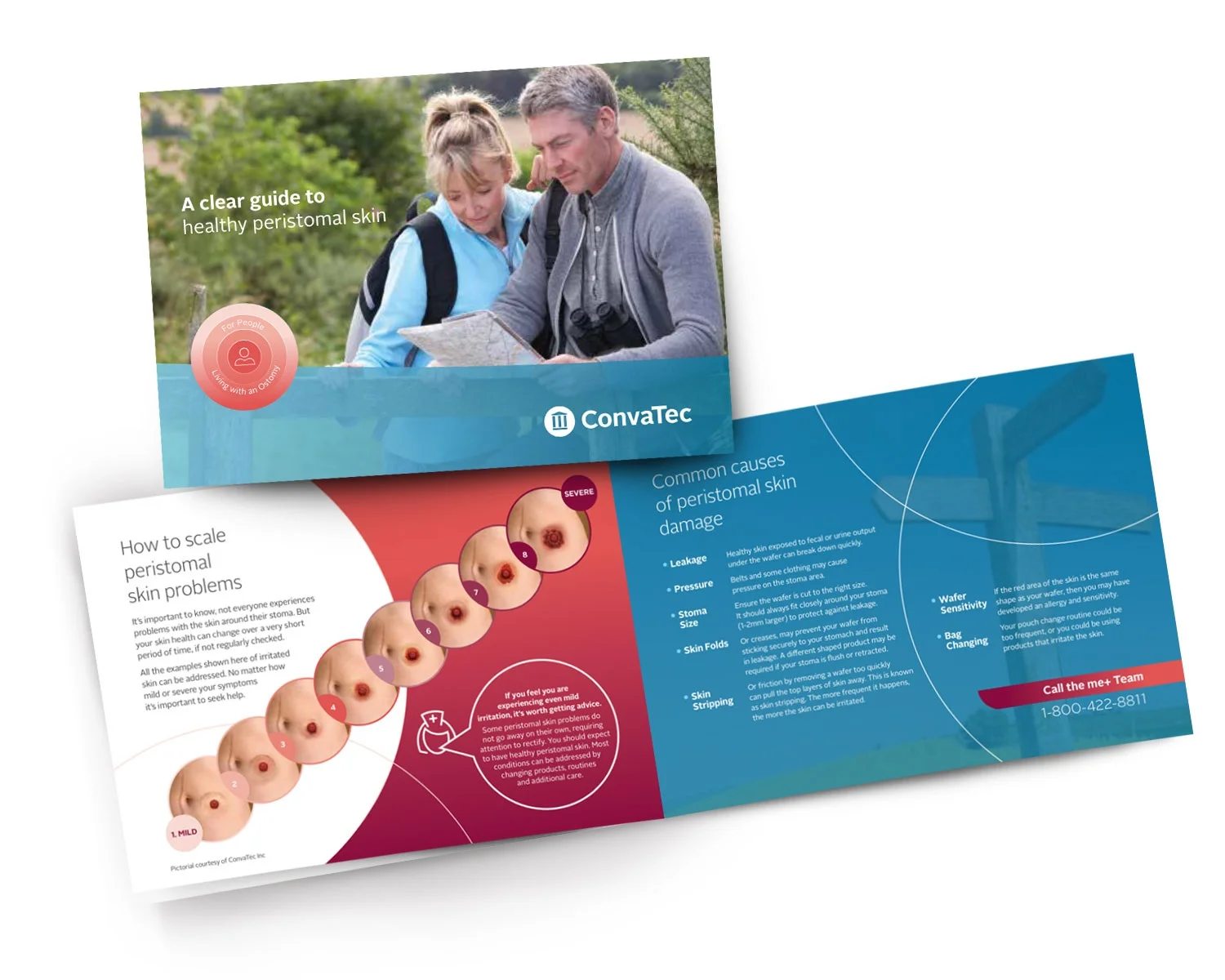 Et omslag av brosjyren: 'Clear Guide to Healthy Peristomal Skin' dykker ned i skaleringsproblemer og vanlige årsaker til hudskader.